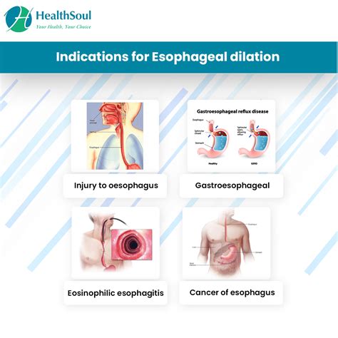 balloon deepthroat|What to Expect With Esophageal Dilation .